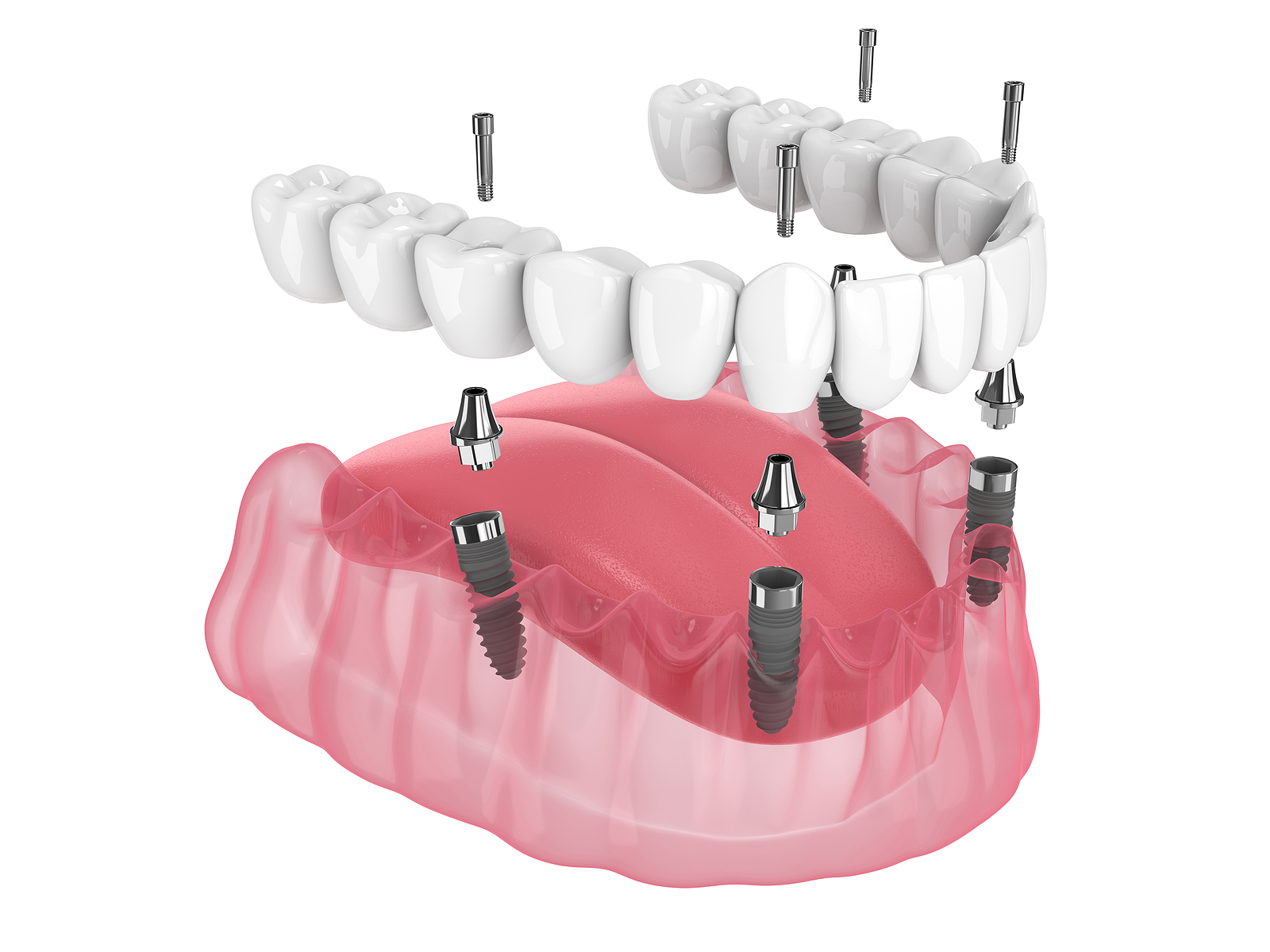 The Ultimate Guide to All-on-4 Implants in Elk Grove, CA
