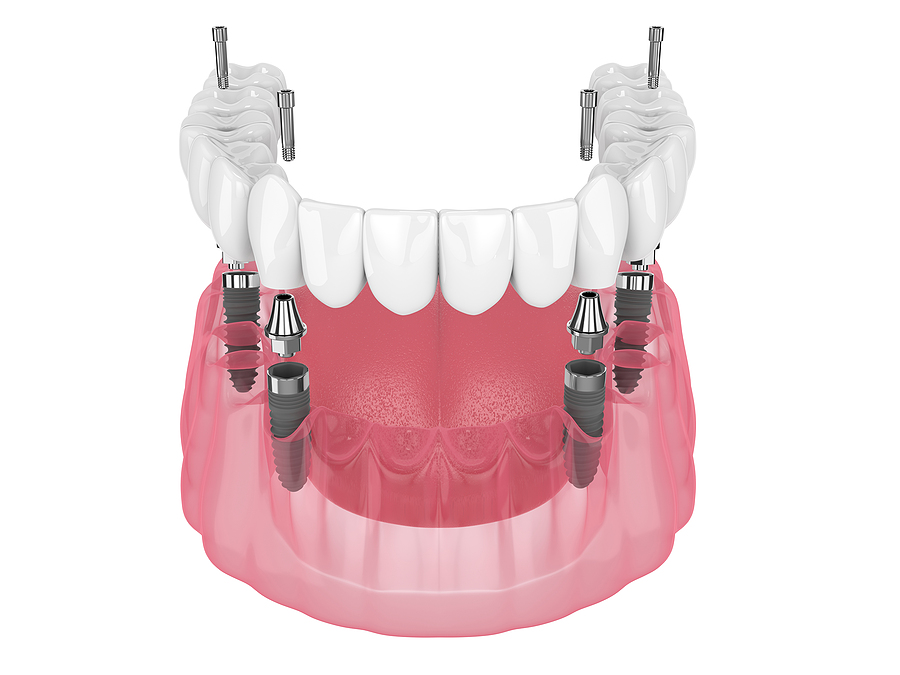 Regain Your Smile with All-on-4 Implants in Elk Grove, CA