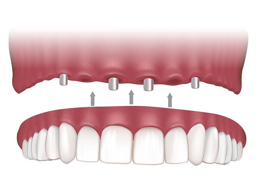 Transform Your Smile with All-on-4 Implants in Elk Grove, CA