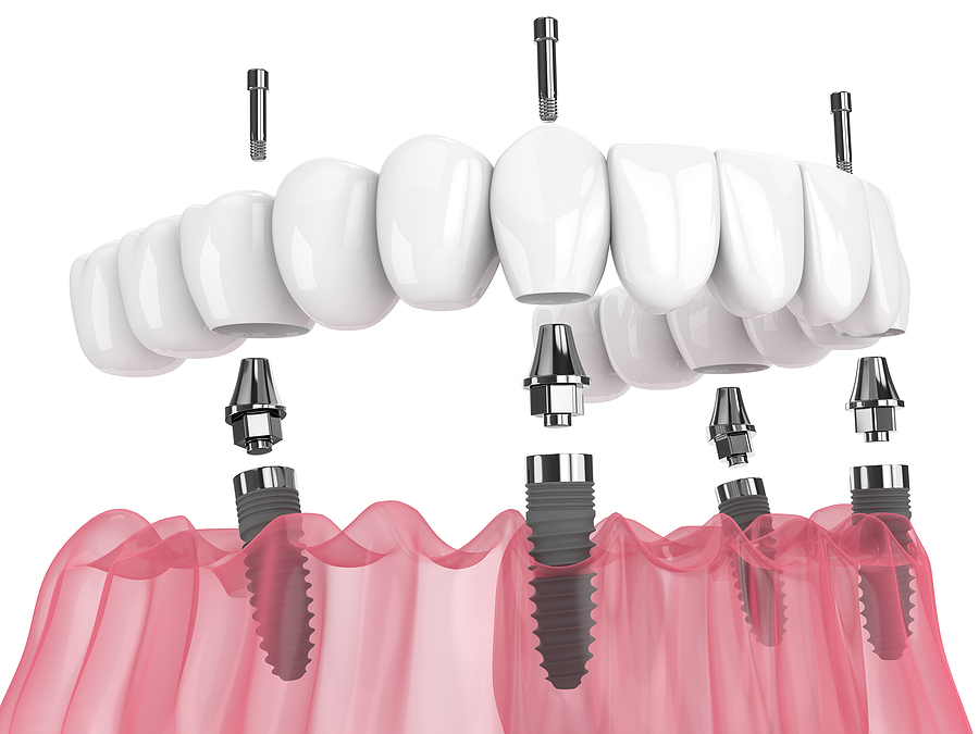 A Complete Guide to All-on-4 Implants in Elk Grove, CA