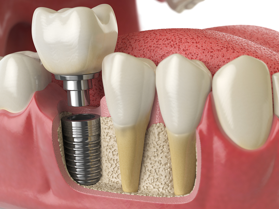The Ultimate Guide to Dental Implants: Benefits, Procedure, and Care