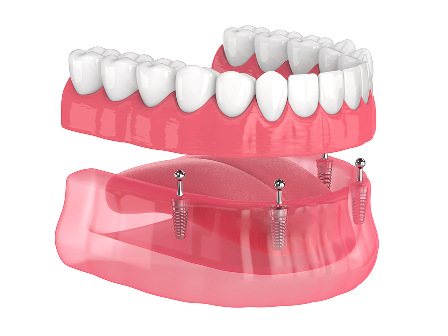 Revolutionizing Smiles with Denture Supported Implants