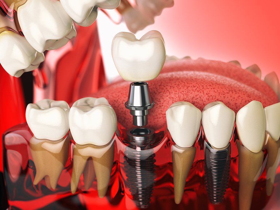 Understanding Implant Dentistry in Elk Grove, CA: A Permanent Solution for Missing Teeth