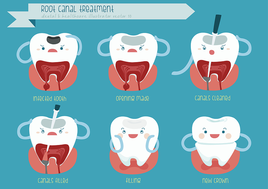 Saving Your Smile: Root Canal Therapy in Elk Grove, CA