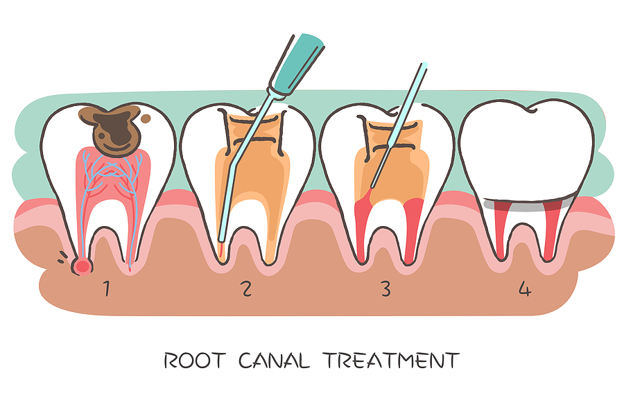 The Importance of Root Canal Therapy in Elk Grove, CA: Saving Your Natural Smile