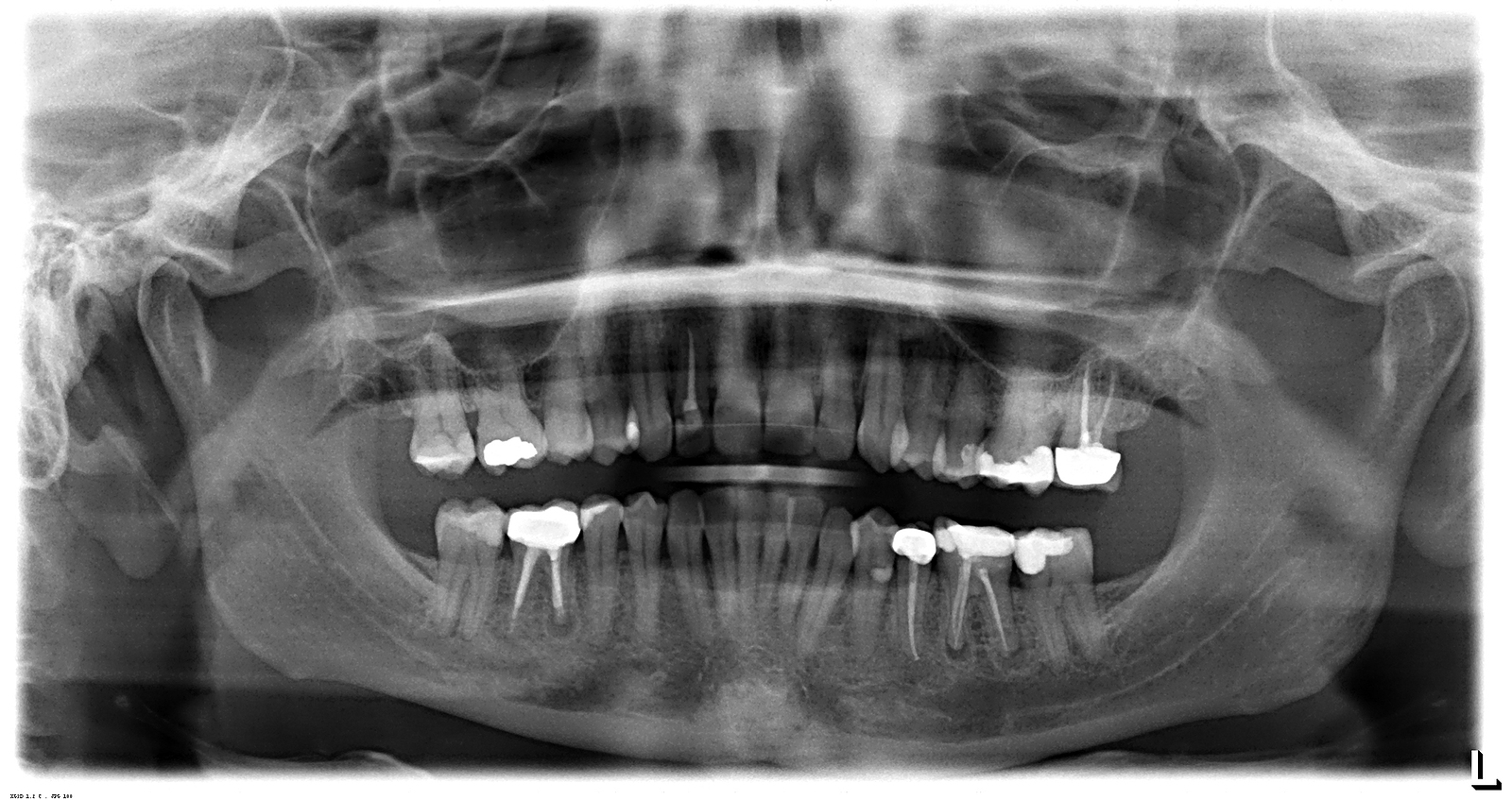 Dental Crowns After Root Canal Therapy: Why They’re Often Needed 