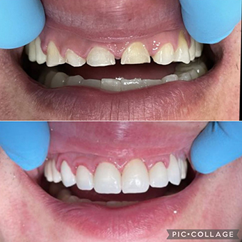 before-and-after